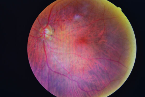 zdjęcie główne_retinopatia cukrzycowa